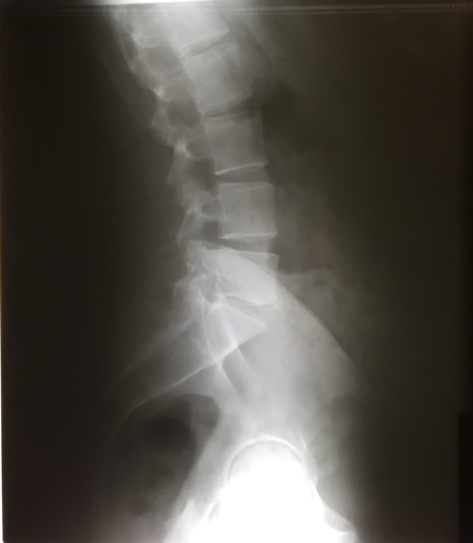 Lateral lumbar spine X-ray — typical clinical imaging reviewed in FRCS revision