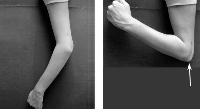 Photo of elbow, with arrow pointing to the olecranon