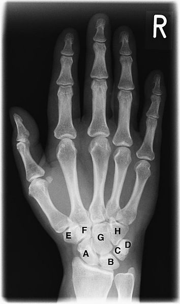 Plain radiograph of a human hand showing the carpal, metacarpal, and phalangeal bones.