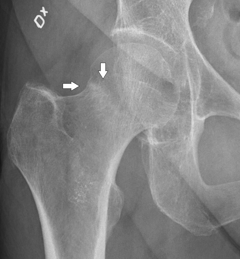 Labeled plain radiograph demonstrating a subtle compressive hip fracture.