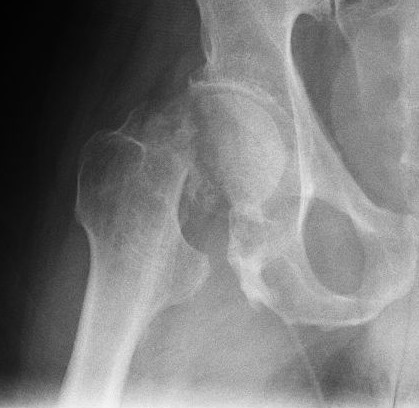 Radiograph of a hip joint showing a femoral neck fracture.