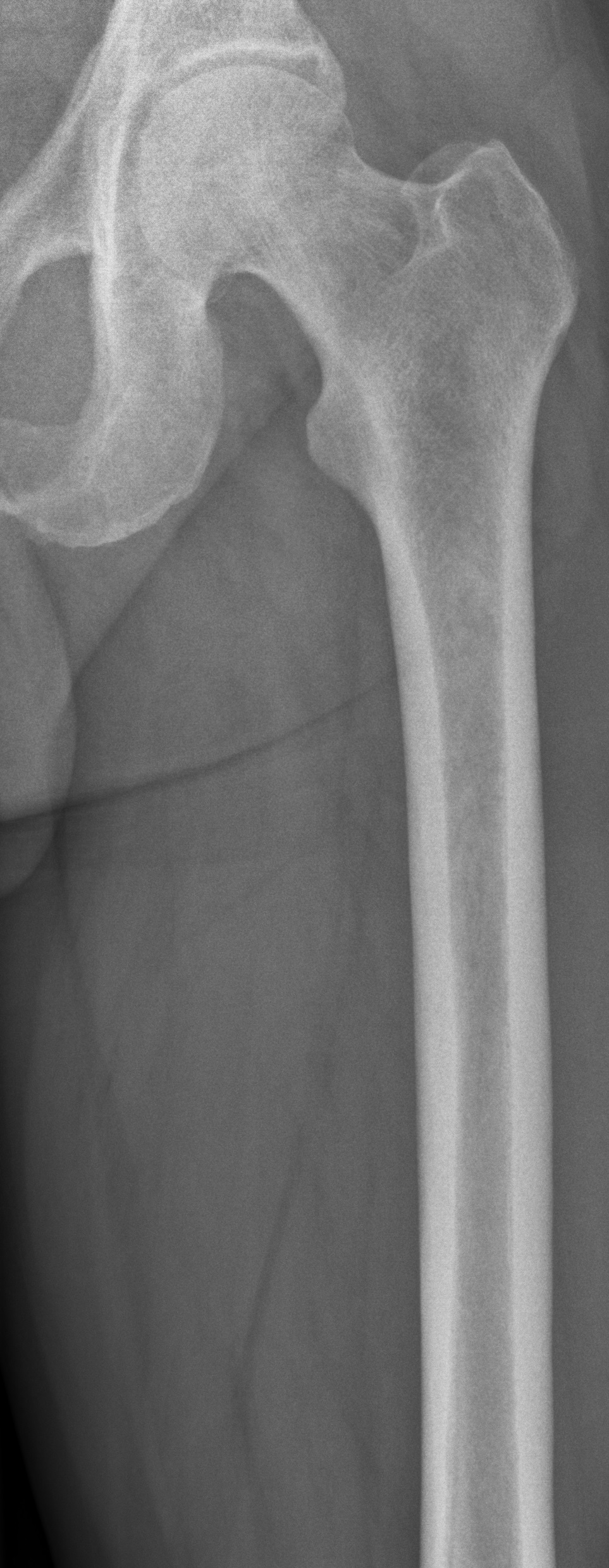 Radiograph of a left femur used as a reference baseline for orthopaedic imaging.