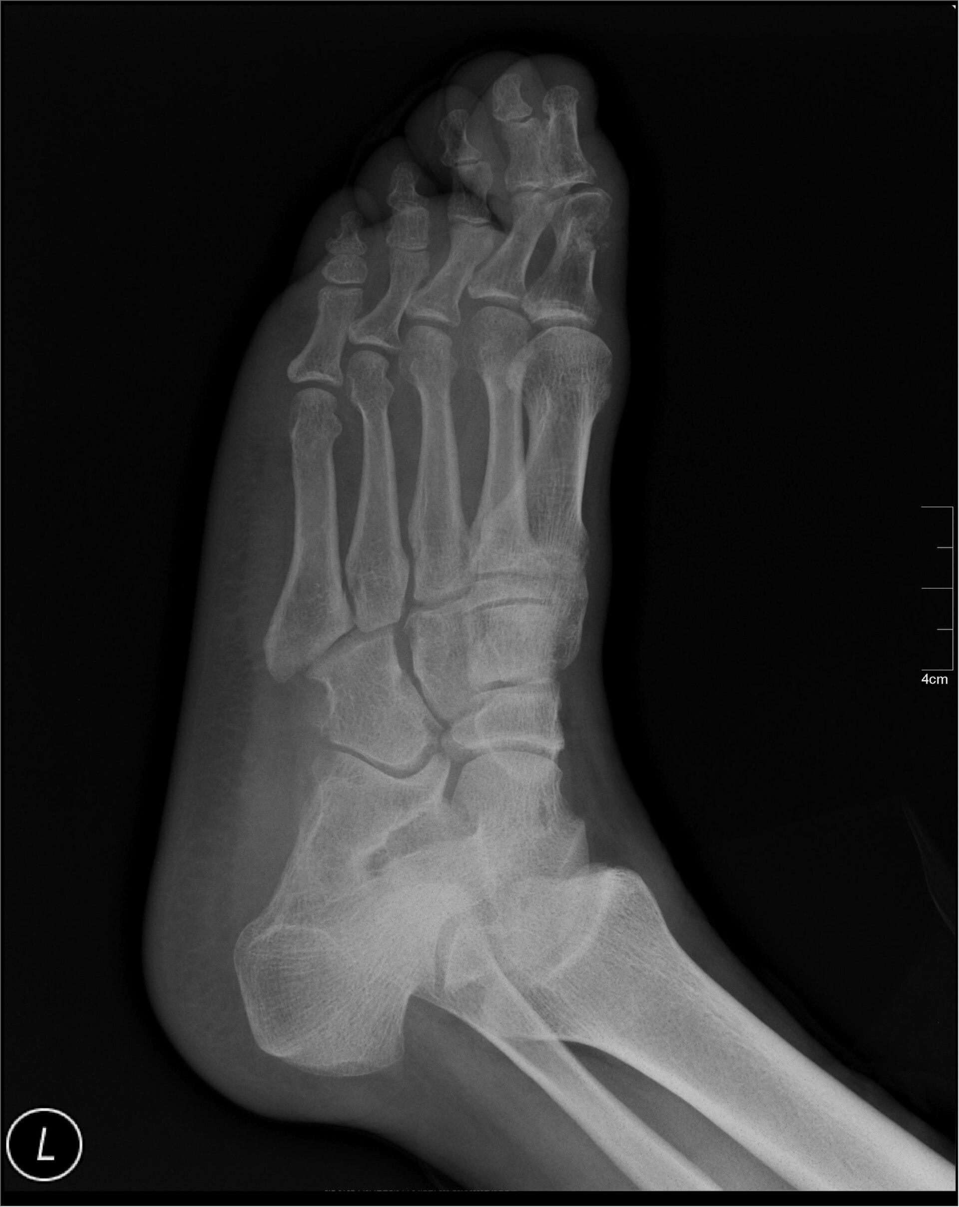 Plain radiograph of a human foot showing tarsal, metatarsal, and phalangeal bones.