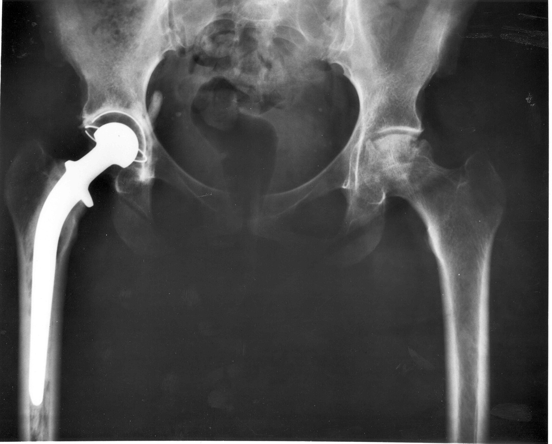 Radiograph of a total hip replacement showing the prosthetic femoral component.