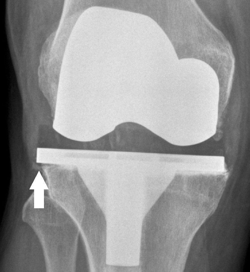 Annotated X-ray of a knee prosthesis showing component overhang after total knee arthroplasty.