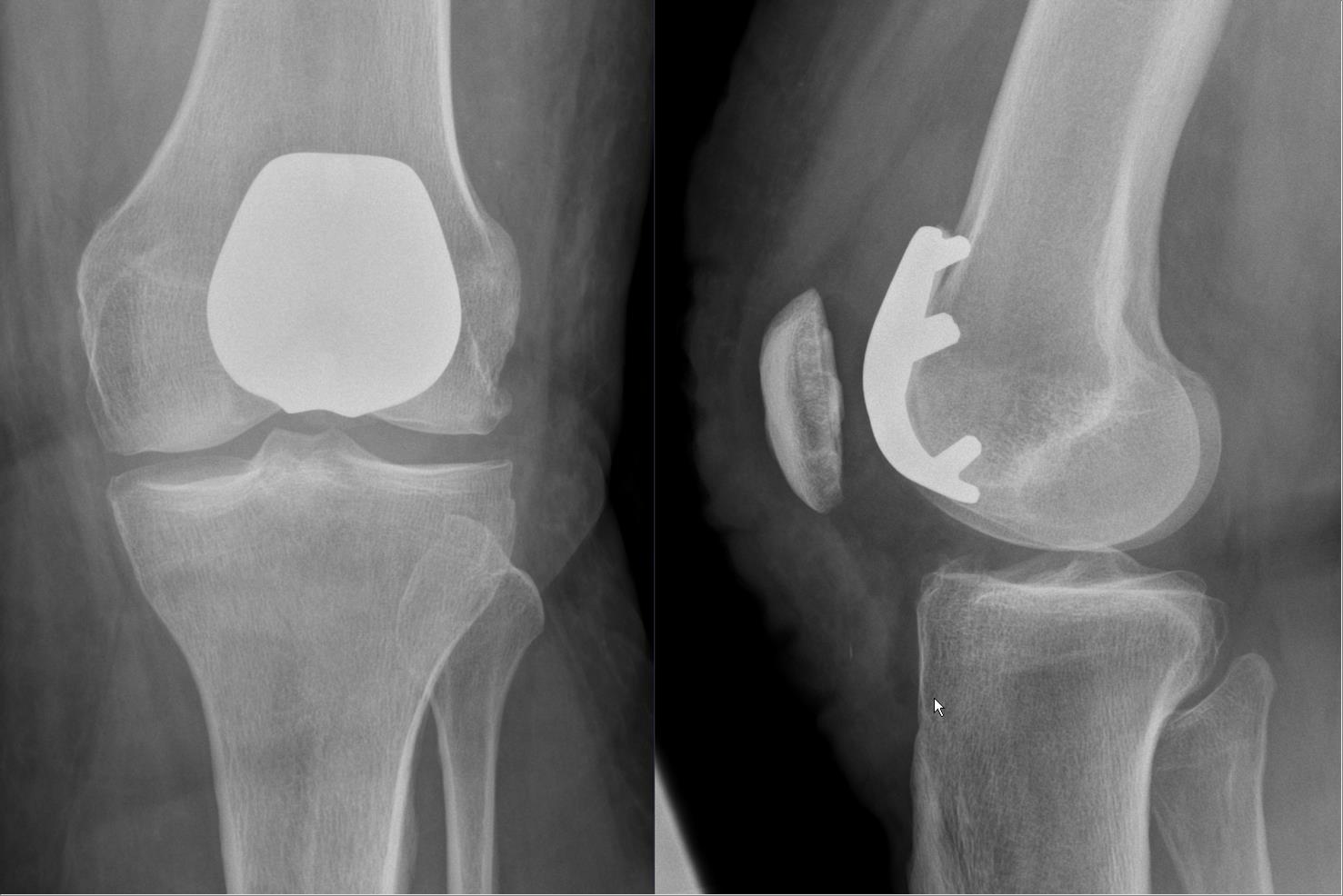 Lateral radiograph of a retropatellar knee joint prosthesis.