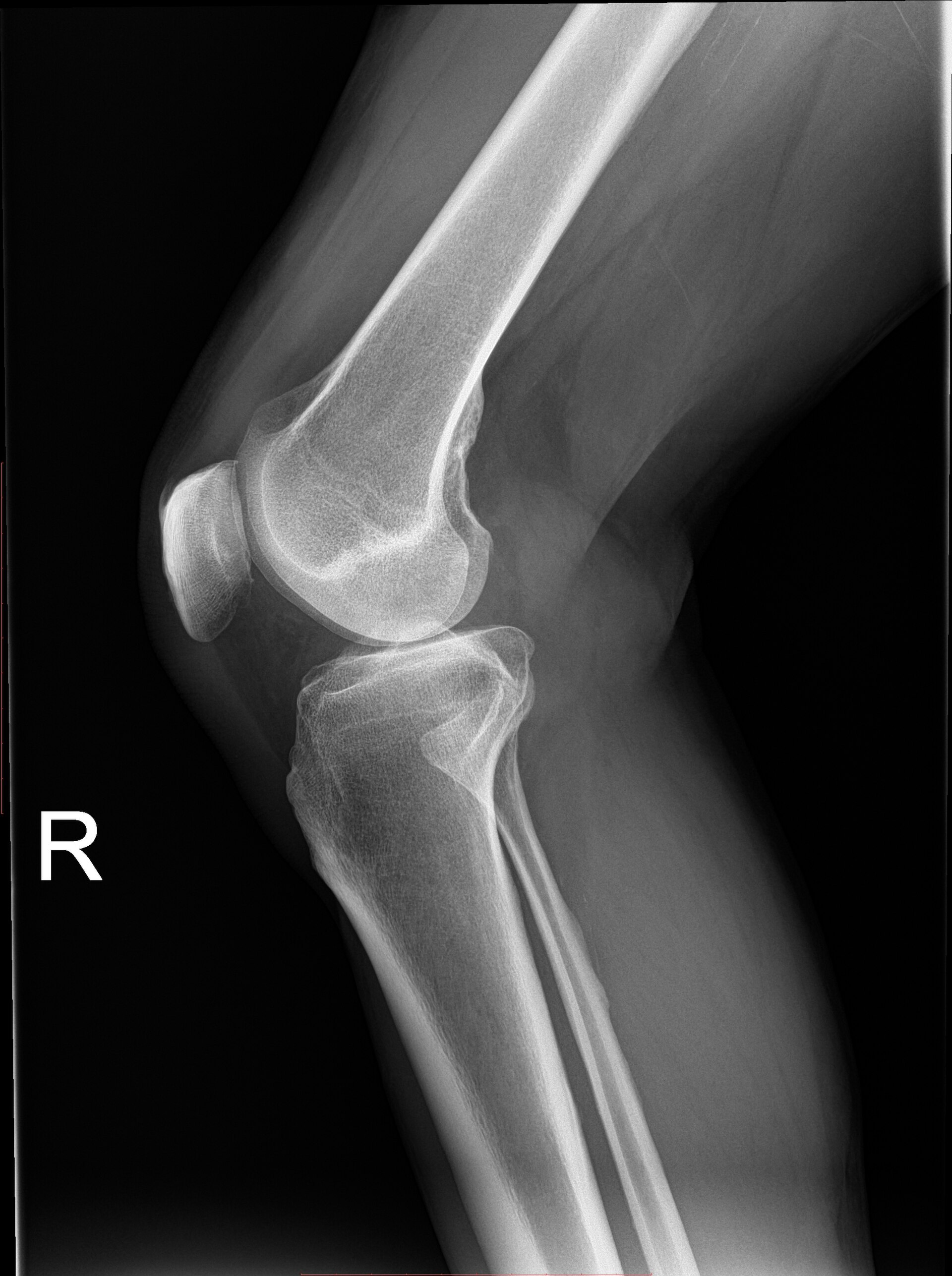 Plain radiograph of a human knee joint showing the femur, tibia, and patella.