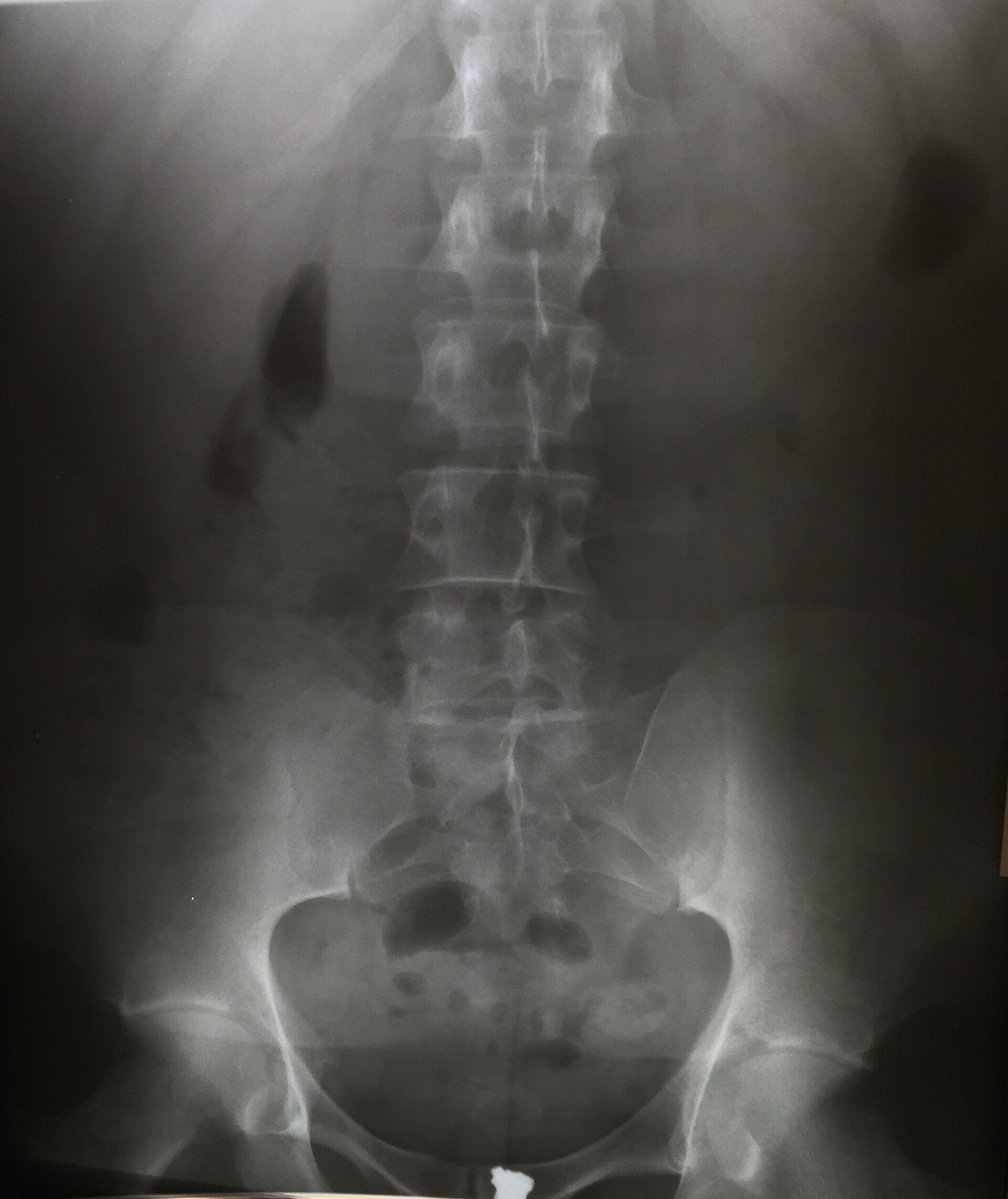 Anteroposterior radiograph of the lumbar spine.