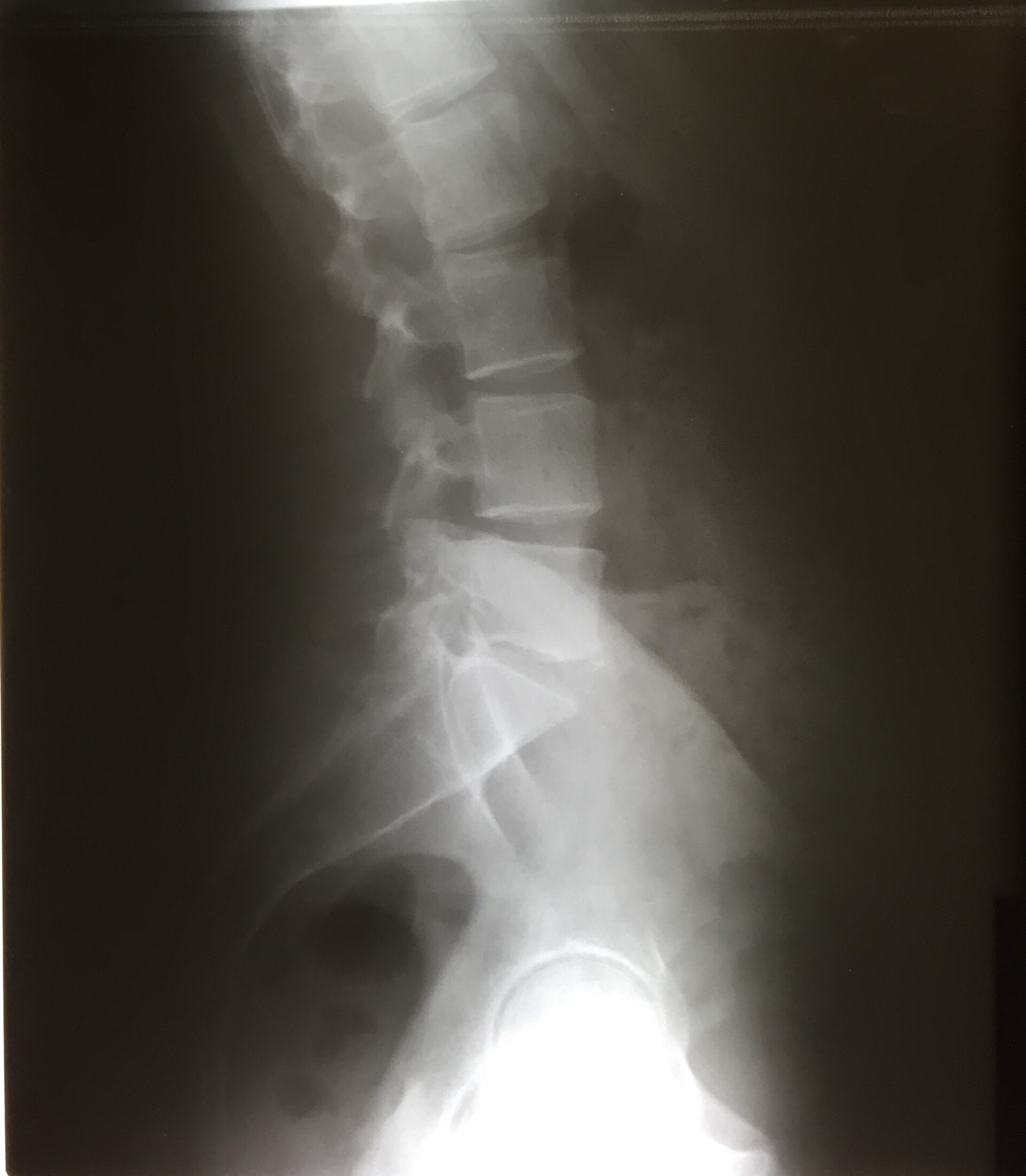 Lateral radiograph of the lumbar spine.
