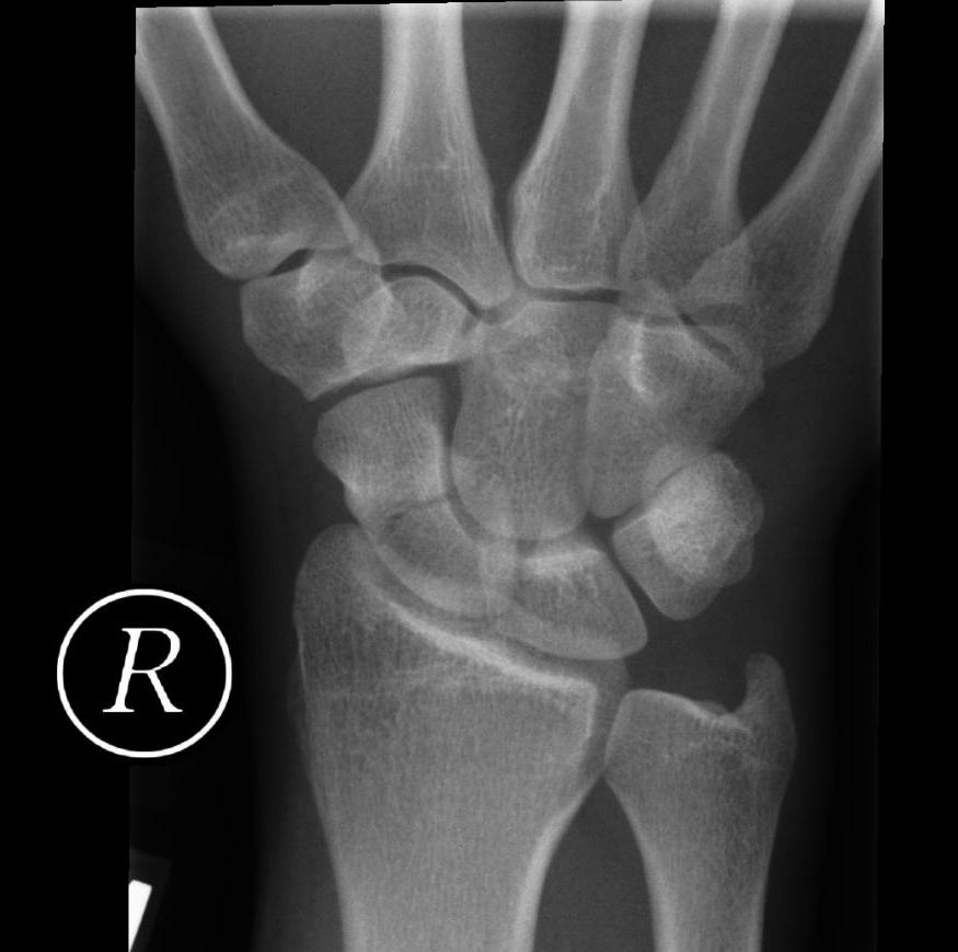 Radiograph of the wrist demonstrating a scaphoid bone fracture.