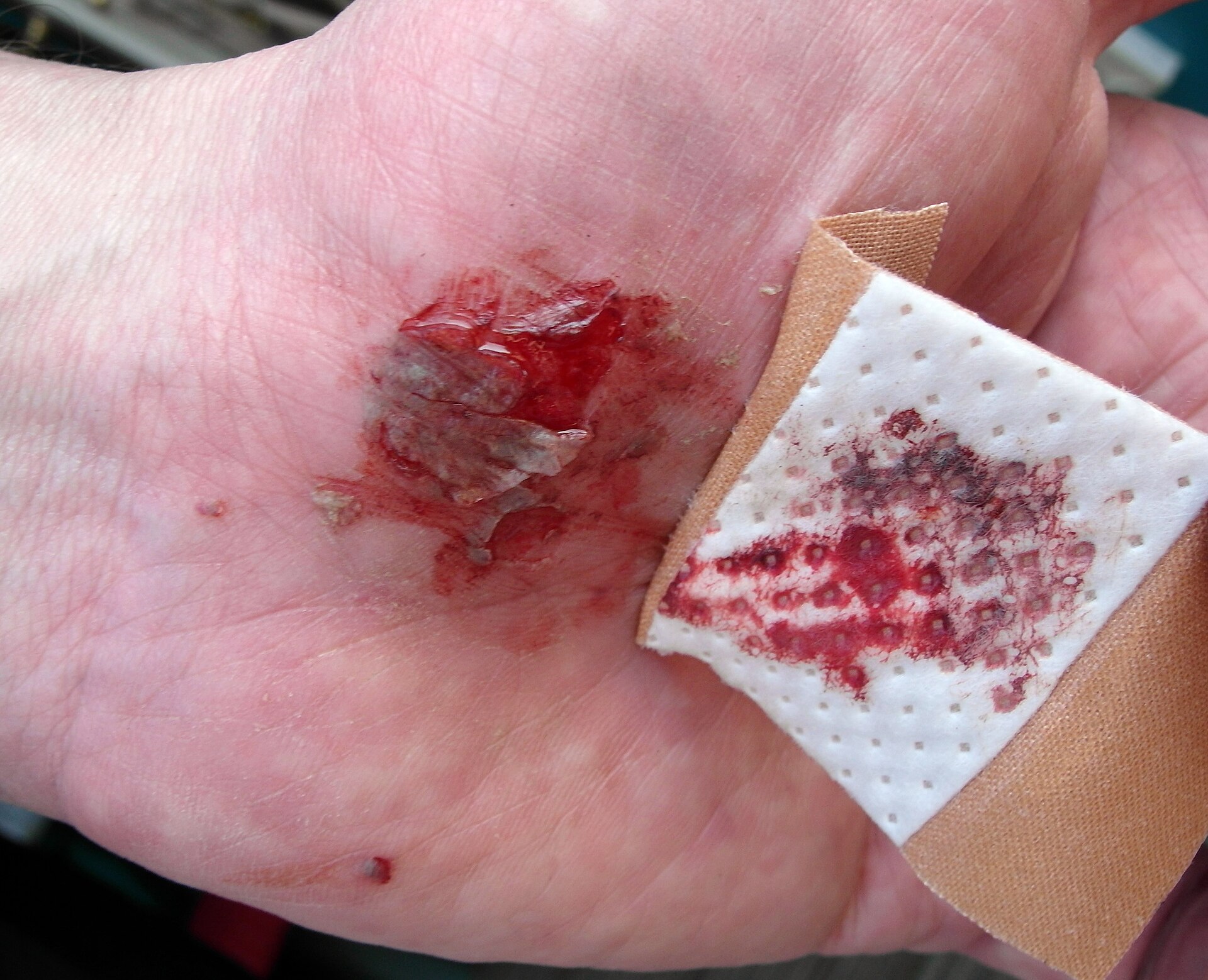 Knee injury sustained after a bicycle fall, illustrating a common sports trauma.