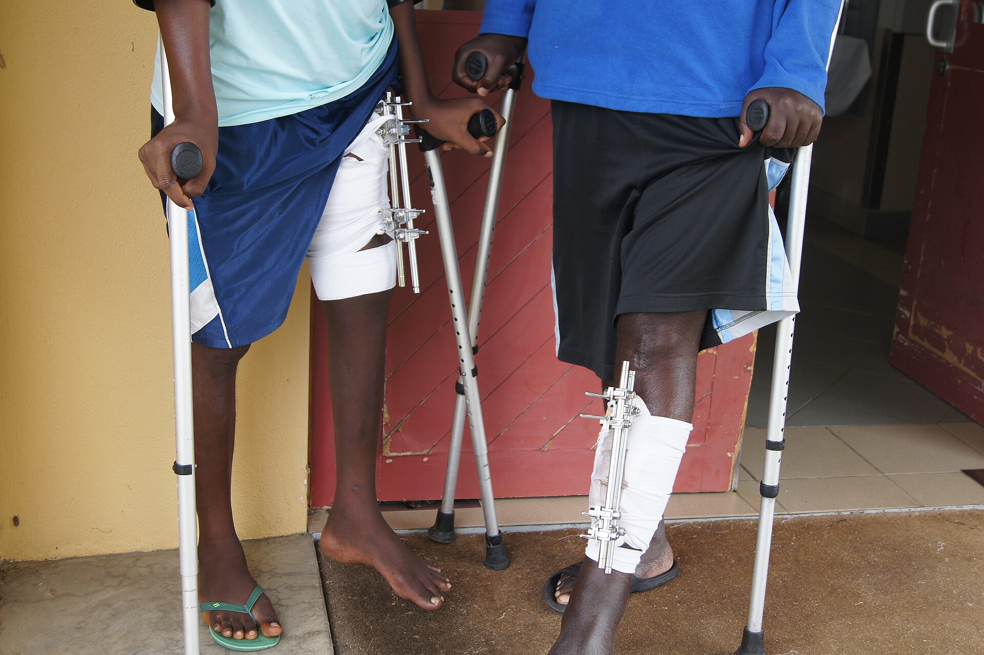 Patient with a lower-limb external fixator device at a hospital in Huíla Province, Angola.
