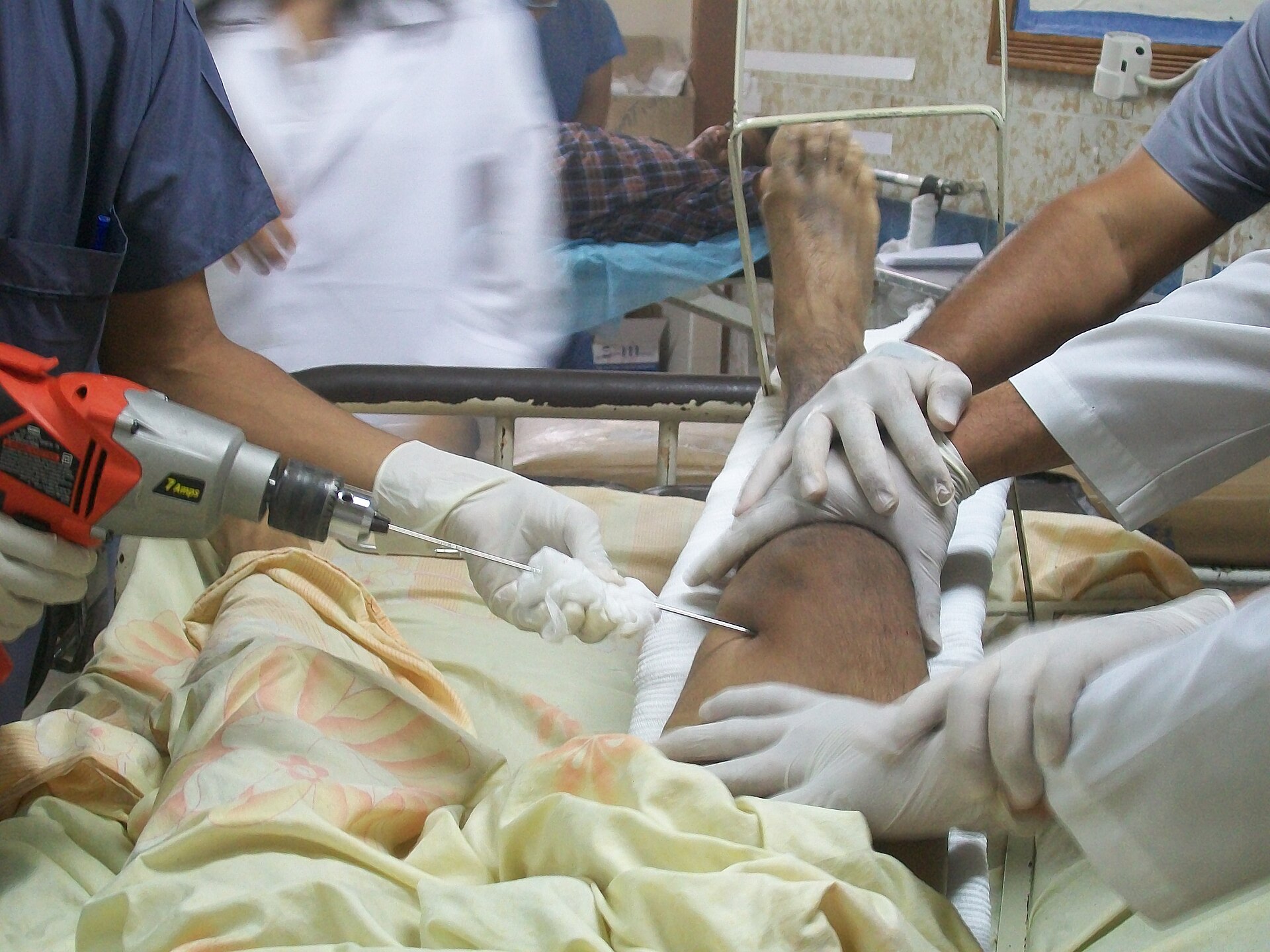 Placement of a distal femoral traction pin during an orthopaedic procedure.