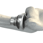 Radial head replacement