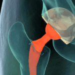 Advancements in Bone and Tissue   Transplantation Techniques
