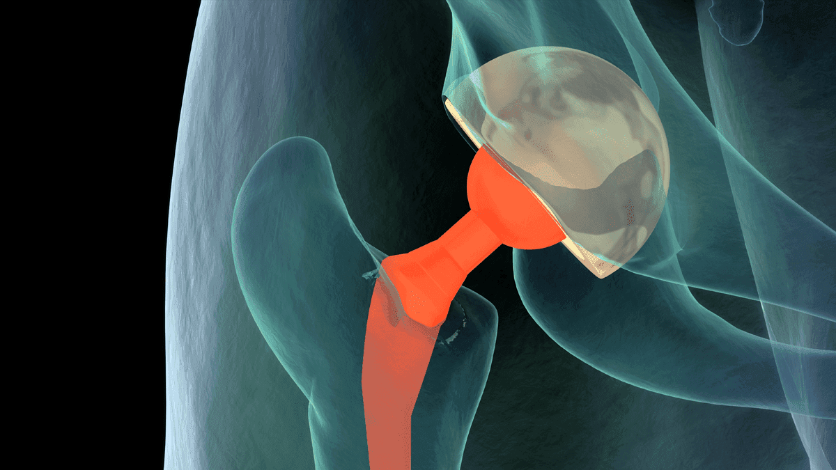 Advancements in Bone and Tissue Transplantation Techniques