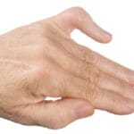 Boutonnière Deformity