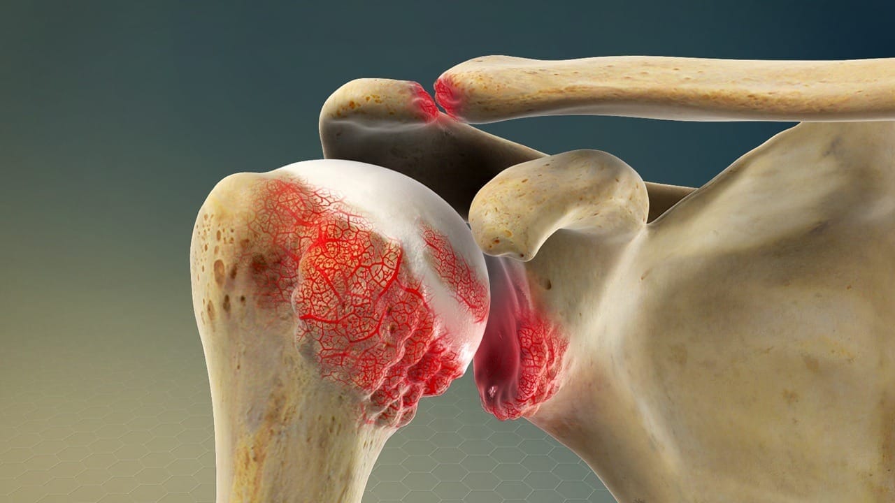 Shoulder Arthritis