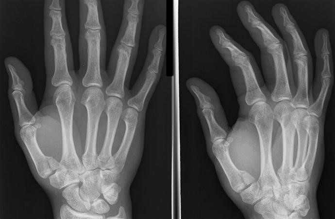 Base of Thumb Fractures