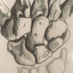 Lunotriquetral Ligament Injury