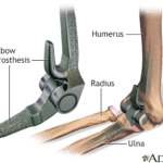 Total Elbow Replacement