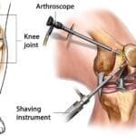 Arthroscopy