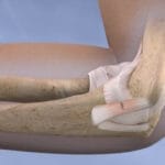 Ulnar Collateral Ligament Reconstruction of the Elbow