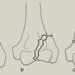 Supracondylar and Intercondylar Humeral Fractures