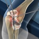 Open and Arthroscopic Treatment of Lateral Epicondylitis (Tennis Elbow)