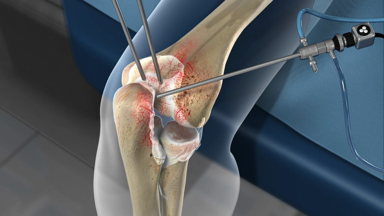 Open and Arthroscopic Treatment of Lateral Epicondylitis (Tennis Elbow)