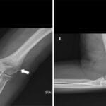 Radial Head and Neck Fractures