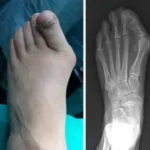 Bunion Surgery