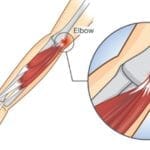 Open Treatment of Medial Epicondylitis (Golfer’s Elbow)