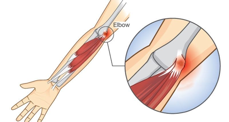 Open Treatment of Medial Epicondylitis (Golfer’s Elbow)