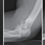Terrible Triad Injury of the Elbow