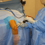 Arthroscopic Treatment of Cartilage Injuries and Osteochondritis Dissecans