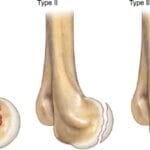 Capitellum and Capitellar-Trochlear Shear Fractures