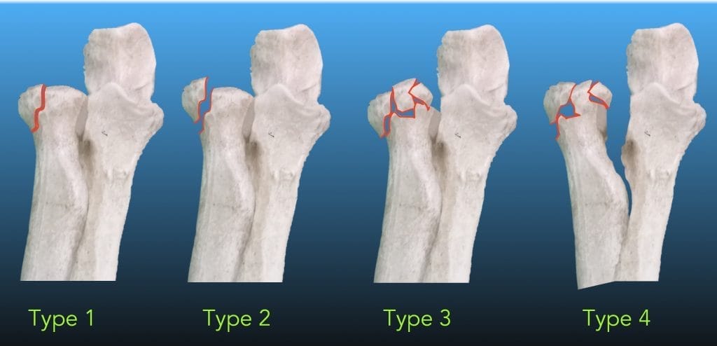 Ortho Globe | Radial Head and Neck Fractures