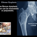 Fibrous Dysplasia