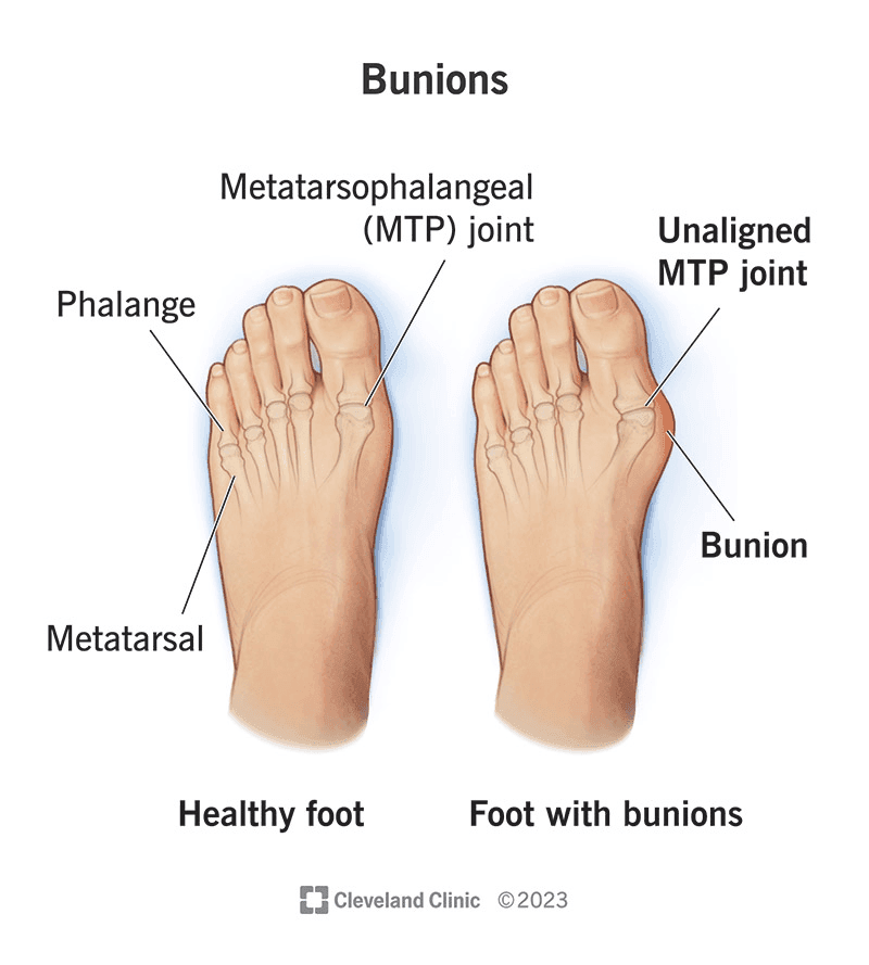 Understanding and Managing Bunions
