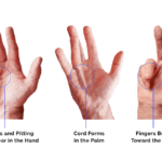 Post-Surgery Exercises for Dupuytren’s Contracture