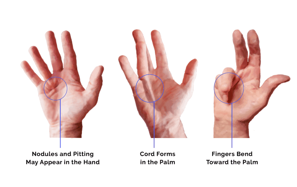 Post-Surgery Exercises for Dupuytren’s Contracture