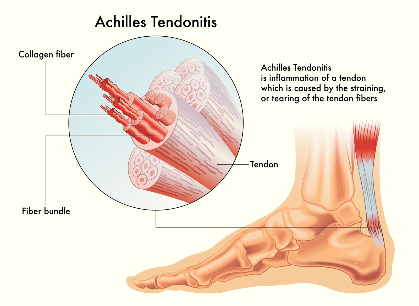 Achilles Tendinitis: Understanding, Symptoms, and Treatment