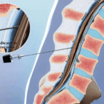 Spinal Injections: Pain Relief and Diagnosis Guid