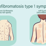 Neurofibromatosis: Understanding, Managing, and Living with the Condition