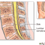 Bone Grafts in Spine Surgery