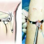 Reconstruction for Interosseous Ligament Disruption