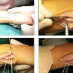 Extensor Carpi Ulnaris Subluxation