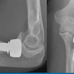 Total Elbow Arthroplasty: An Overview of Modern Clinical Approaches