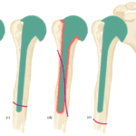 Periprosthetic Glenoid Fractures